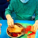 高难度右腕离断再植，紧急接诊！青岛友谊整骨医院成功完成高难度右腕离断再植手术